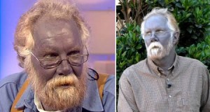 rare-skin-condition-argyria